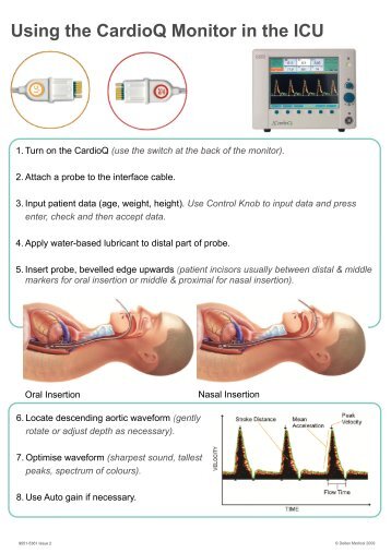 Using the CardioQ Monitor in the ICU - Deltex Medical
