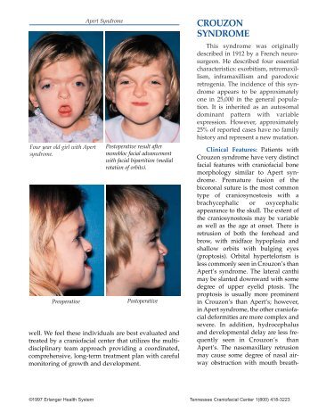 CROUZON SYNDROME - Erlanger Health System