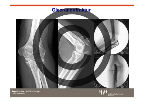 Verletzungen der oberen ExtremitÃ¤t