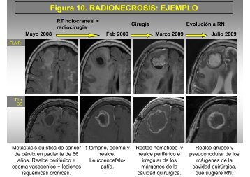 Figura 10. RADIONECROSIS: EJEMPLO