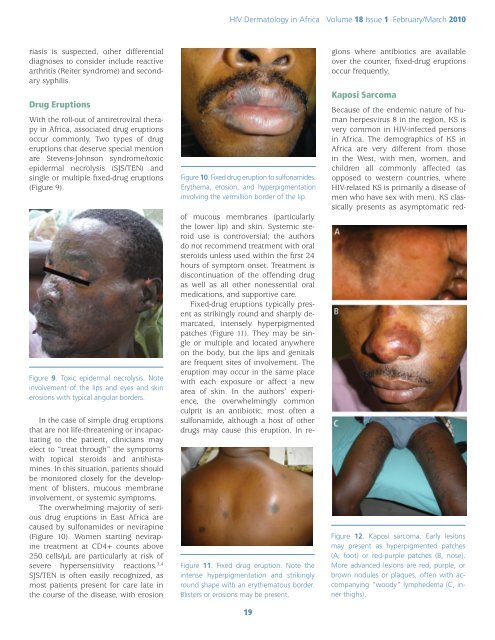 Dermatologic Manifestations of HIV in Africa - International AIDS ...