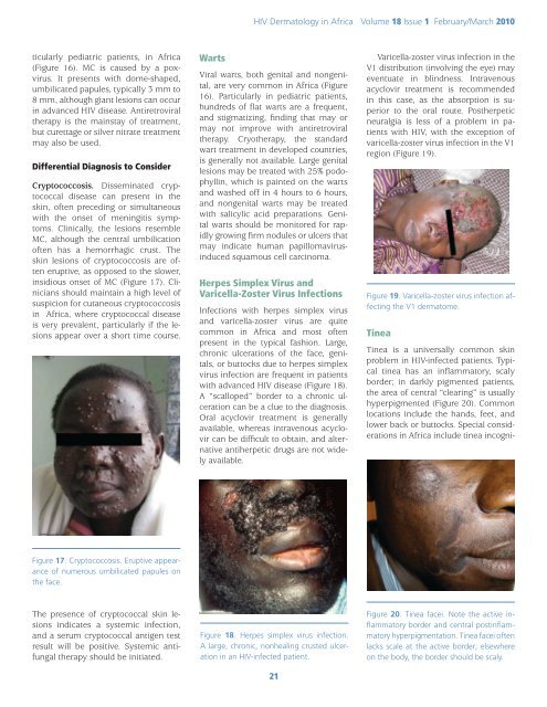 Dermatologic Manifestations of HIV in Africa - International AIDS ...