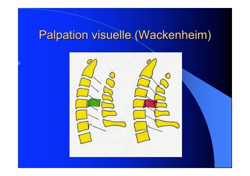 Myelopathies cervicales S. Benzakin - ClubOrtho.fr