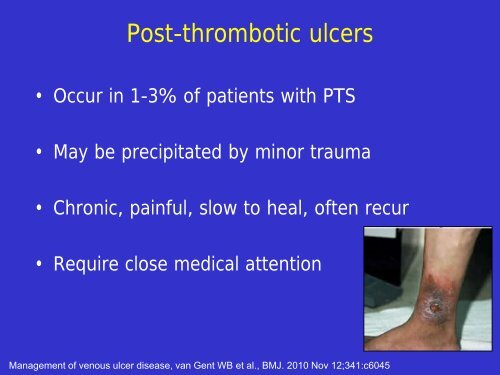 Post-thrombotic syndrome