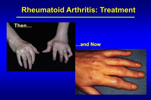 Rheumatoid Arthritis