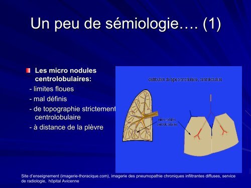 ALVEOLITE ALLERGIQUE EXTRINSEQUE