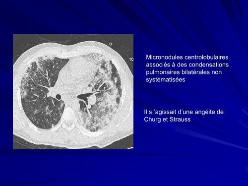 ALVEOLITE ALLERGIQUE EXTRINSEQUE