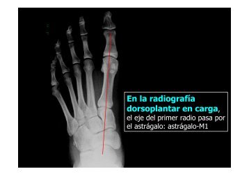 En la radiografía dorsoplantar en carga,