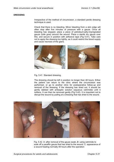 Manual for Male Circumcision under Local Anaesthesia