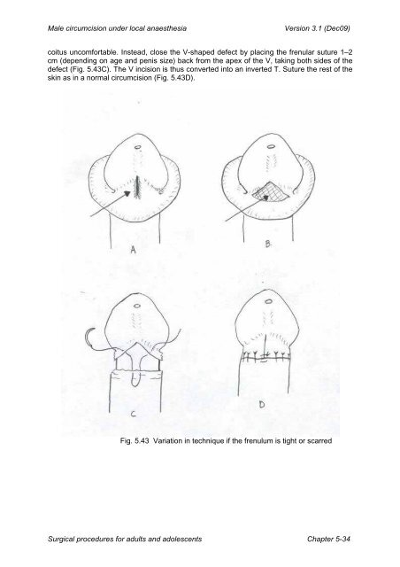 Manual for Male Circumcision under Local Anaesthesia