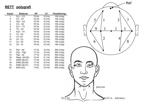 Polygrafi vid Retts syndrom