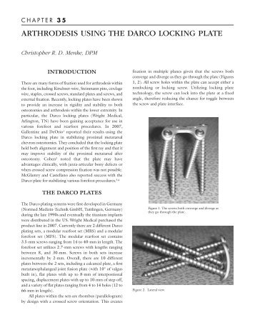 Arthodesis Using the Darco Locking Plate - The Podiatry Institute