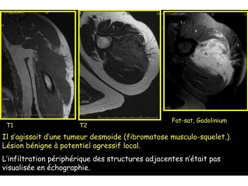 sarcomes des parties molles et hÃ©matomes musculaires spontanÃ©s