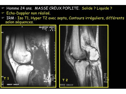 sarcomes des parties molles et hÃ©matomes musculaires spontanÃ©s