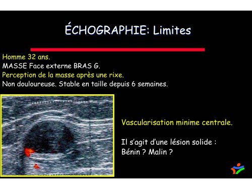 sarcomes des parties molles et hÃ©matomes musculaires spontanÃ©s