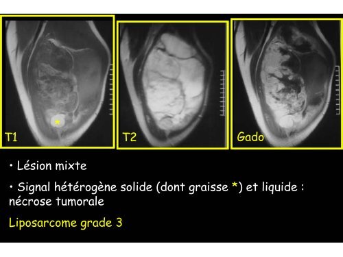 sarcomes des parties molles et hÃ©matomes musculaires spontanÃ©s