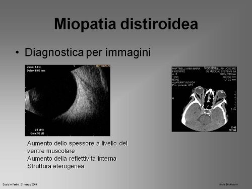 Miopatia oculare distiroidea - La Nostra Famiglia