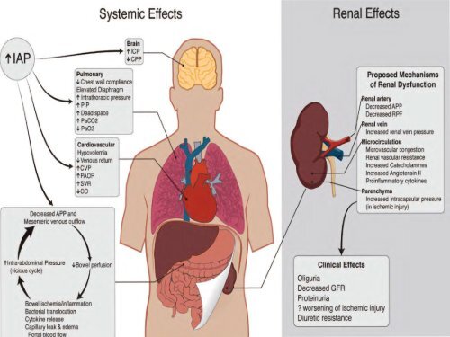 Acute Kidney Injury