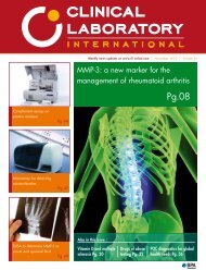 MMP-3: a new marker for the management of rheumatoid arthritis