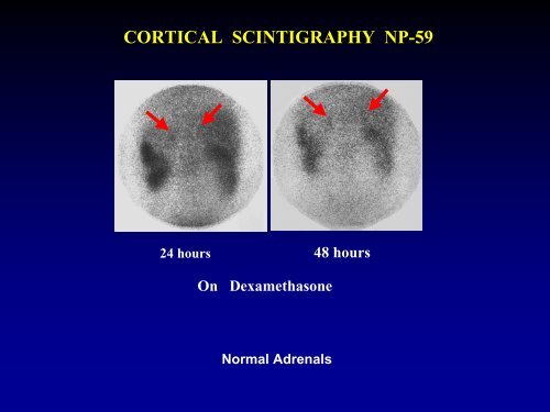 ENDO 3 Adrenal