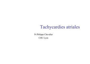 Tachycardies atriales, flutters