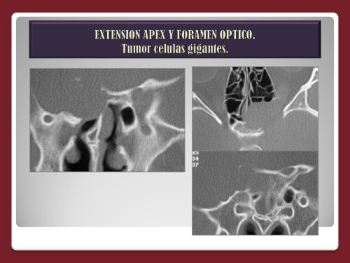 TUMOR OSEO VS SARCOMA OSTEOGENICO.