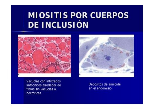 APROXIMACIÃN TERAPÃUTICA A LA DERMATOMIOSITIS