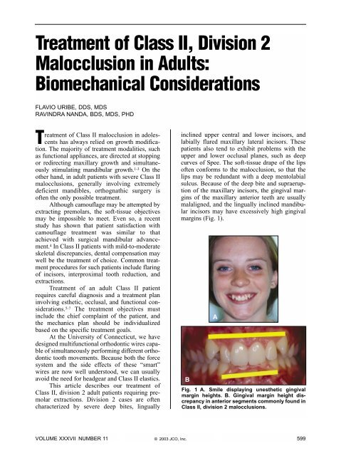 aryabrahmanta-orthodontic-camouflage-treatment-of-skeletal-class-iii