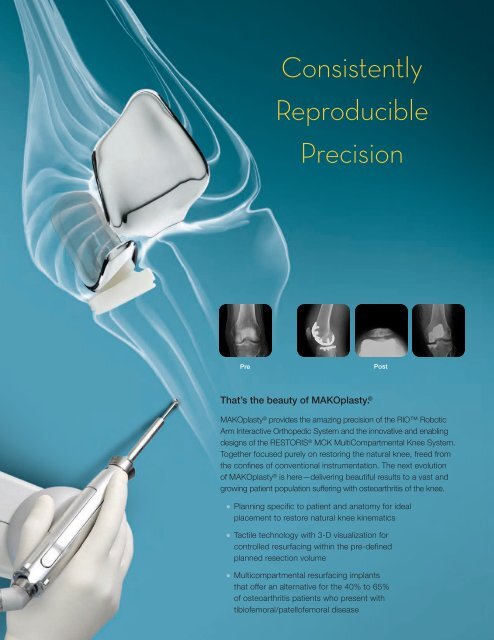 MAKOplasty ® Brochure - MAKO Surgical Corp.