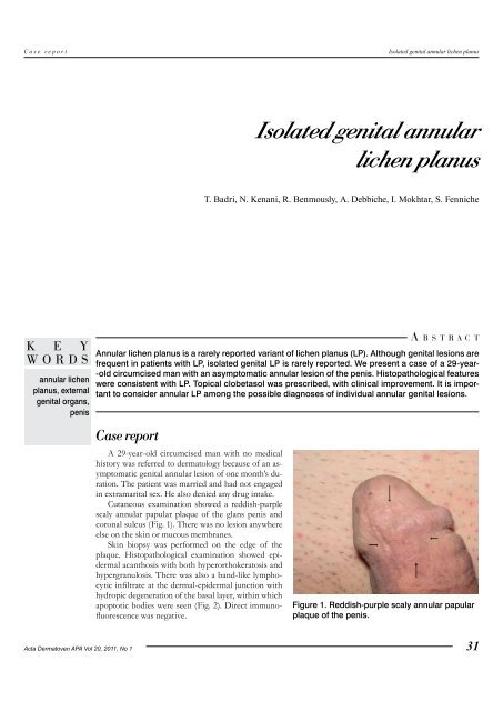 Isolated genital annular lichen planus