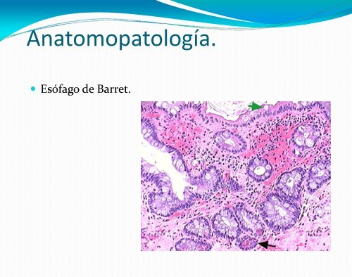 Esofagitis por Reflujo - Asociación de Gastroenterología y ...