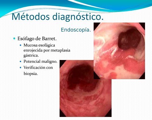 Esofagitis por Reflujo - Asociación de Gastroenterología y ...