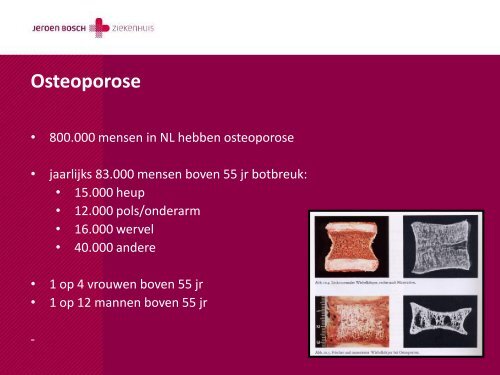 Osteoporose - Jeroen Bosch Ziekenhuis