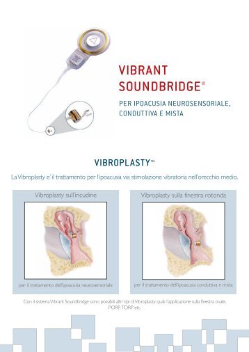 VIBRANT SOUNDBRIDGEÃ‚Â® - Med-El