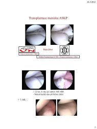 Transplantace menisku ASKP (PDF - 0,43 MB) - SSTA