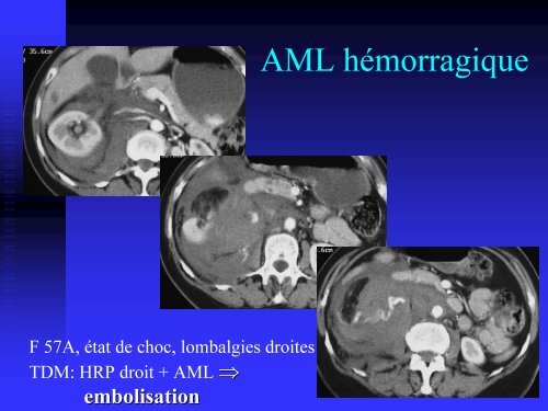 apport de l'embolisation dans le traitement des angiomyolipomes ...