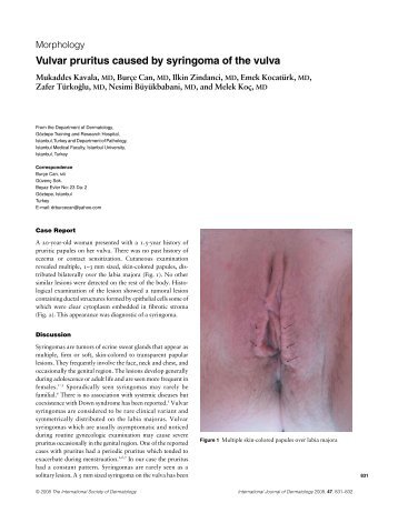 Vulvar pruritus caused by syringoma of the vulva - ResearchGate