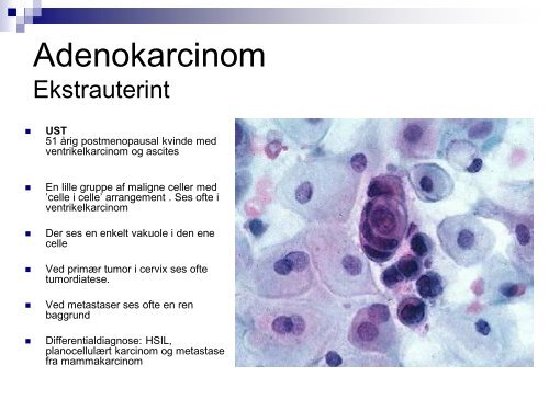 Endometriekancer og extrauterine metastaser - Dansk ...