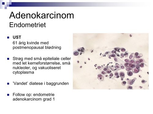 Endometriekancer og extrauterine metastaser - Dansk ...