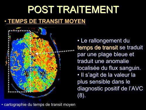 apport de la perfusion cerebrale dans le diagnostic precoce des ...