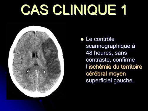 apport de la perfusion cerebrale dans le diagnostic precoce des ...