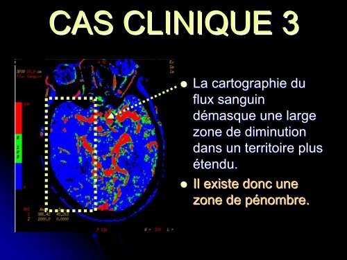 apport de la perfusion cerebrale dans le diagnostic precoce des ...