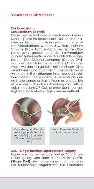 Gallensteine - Krankenhaus Brake