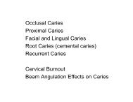 Occlusal Caries Proximal Caries Facial and Lingual Caries Root ...