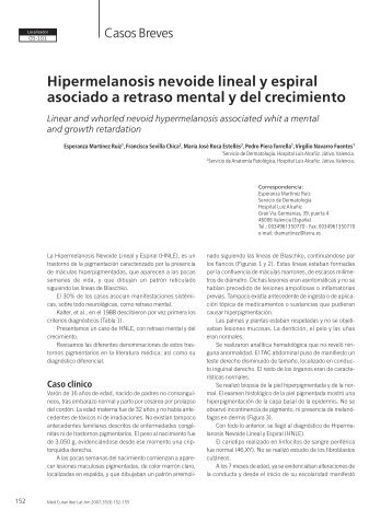 Hipermelanosis nevoide lineal y espiral asociado ... - edigraphic.com