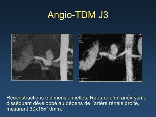 Rupture d'un anÃ©vrysme dissÃ©quant de l'artÃ¨re rÃ©nale sur ...