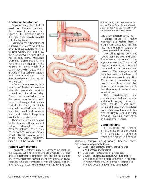 Continent Diversion - United Ostomy Associations of America