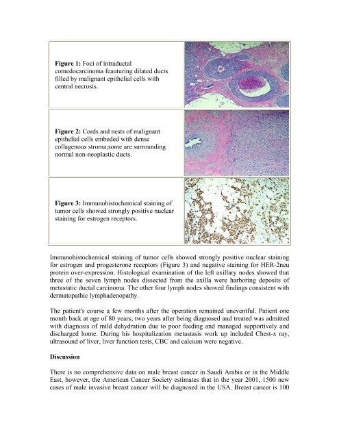 Male breast cancer. Case report and brief review - Middle East ...