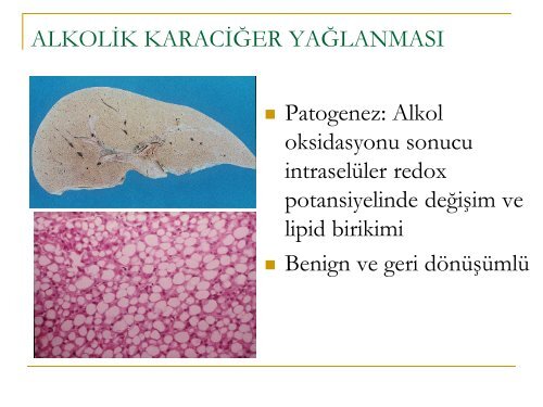 Alkolik KaraciÄer HastalÄ±ÄÄ± - Prof. Dr. Sadettin HÃ¼lagÃ¼