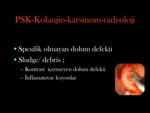 Primer Sklerozan Kolanjit ve Safra YollarÄ± Kanseri - Prof. Dr. Sadettin ...